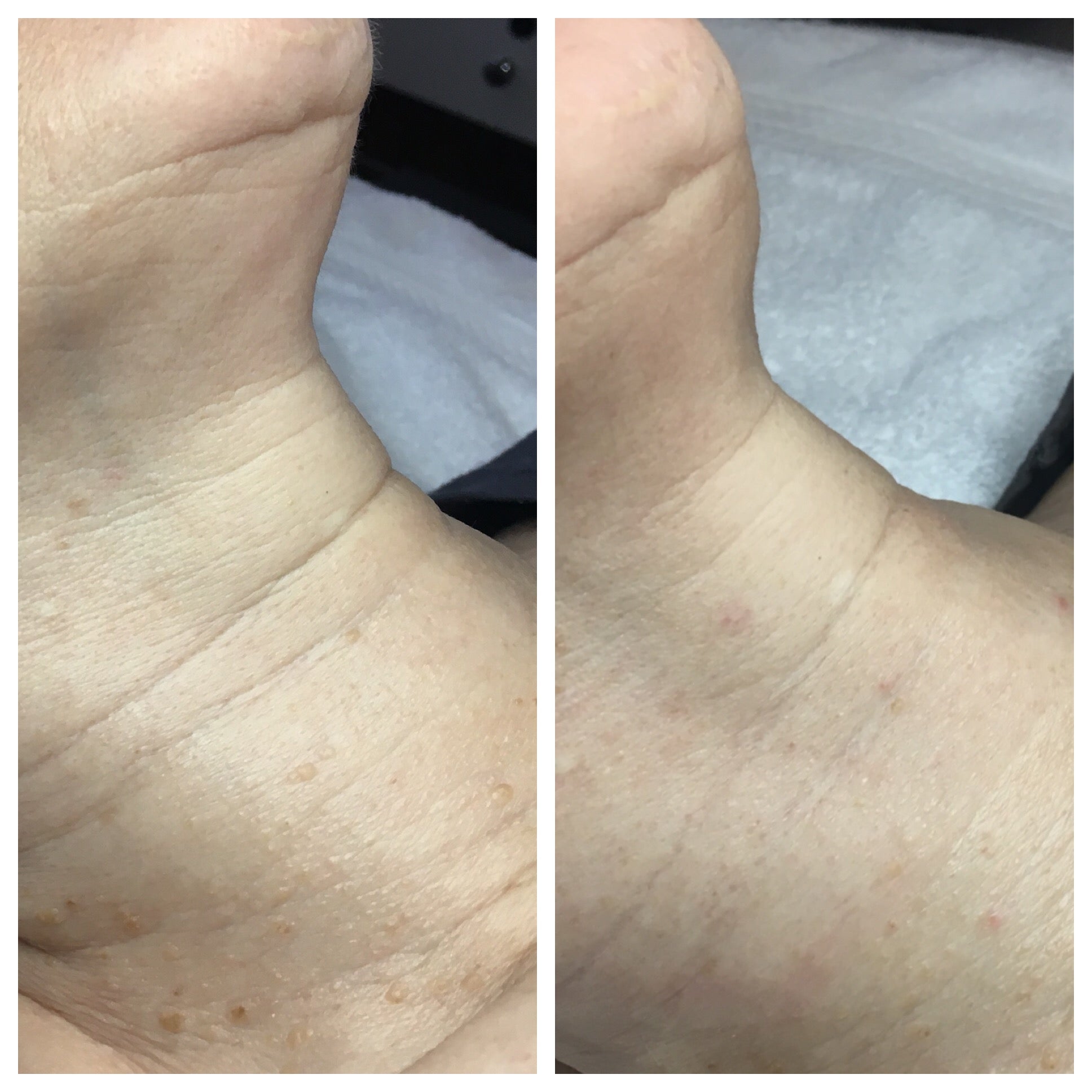 Sculplla Korean filler treatment